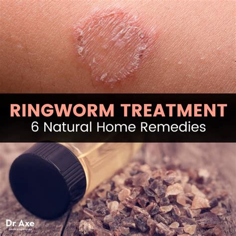 ringworm shower gel|best treatment for ringworm infection.